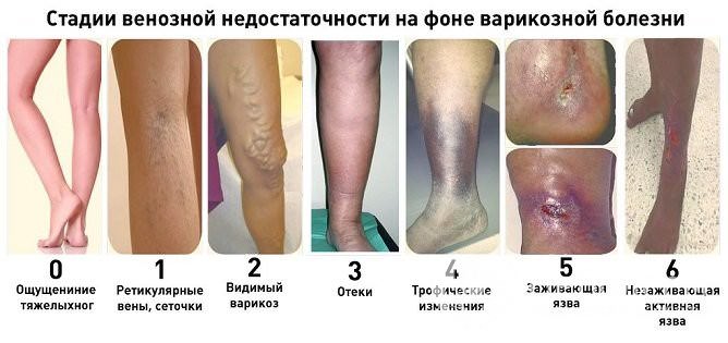 Степени венозной недостаточности на фоне варикозной болезни