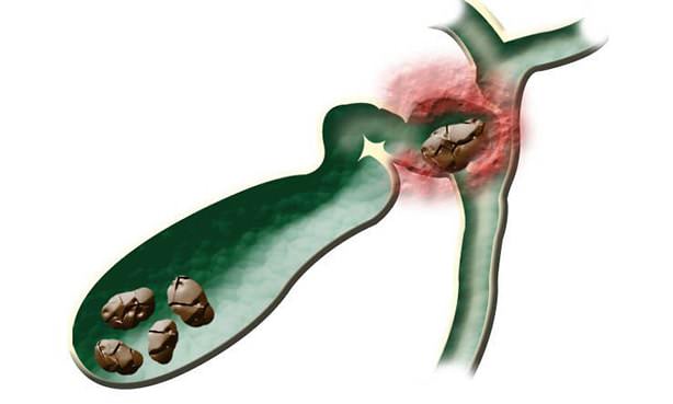 Желчные конкременты