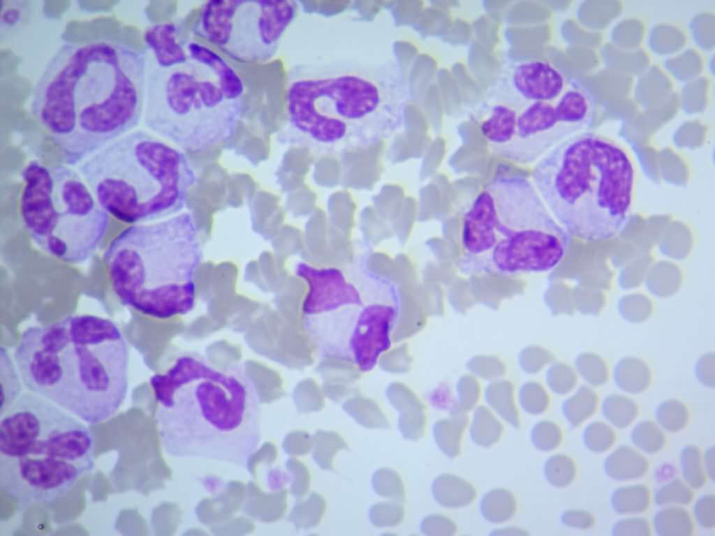 Повышенный и пониженный уровень сегментоядерных нейтрофилов в крови у ребенка. Причины и лечение