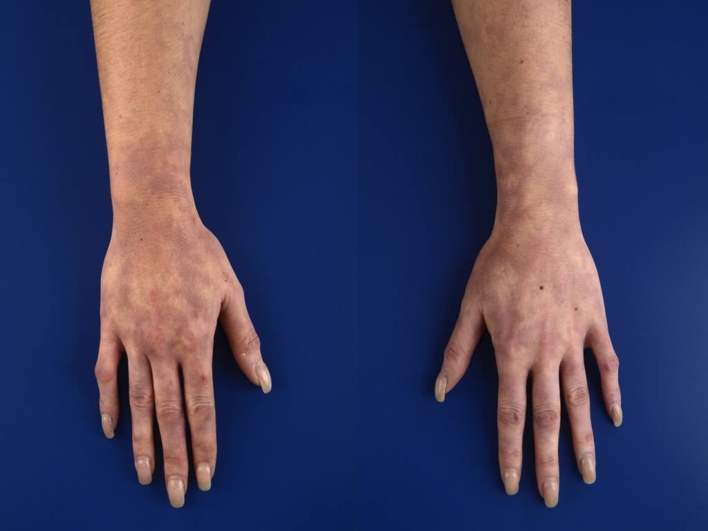 Каковы причины мраморной кожи у взрослых и детей. Симптомы, диагностика и лечение