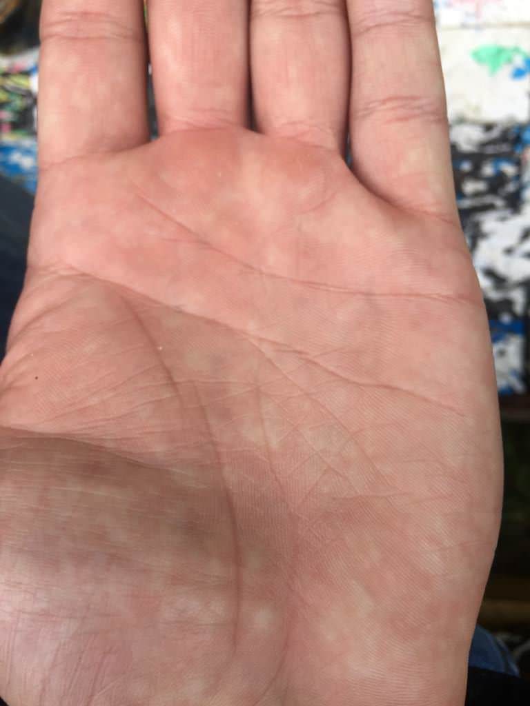 Каковы причины мраморной кожи у взрослых и детей. Симптомы, диагностика и лечение