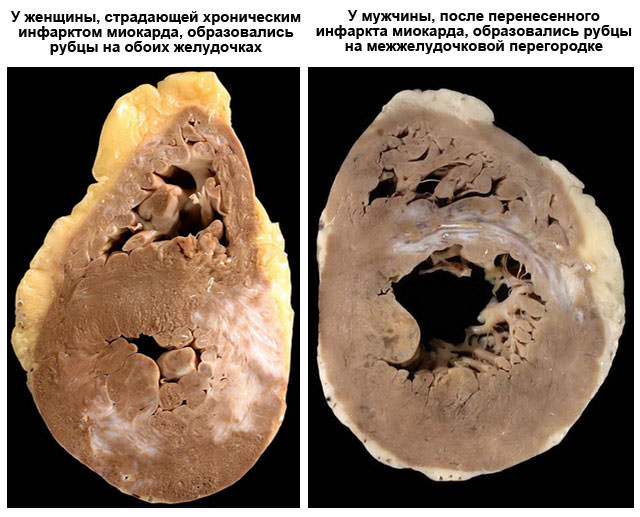 Образование рубцов после инфаркта миокарда