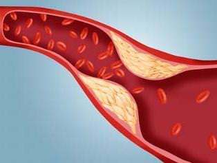 Повышенный холестерин