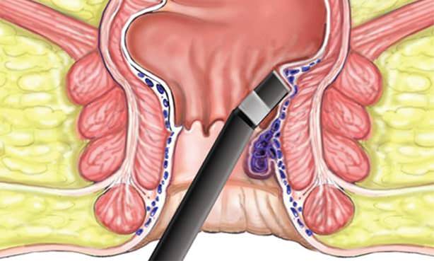 Фотокоагуляция