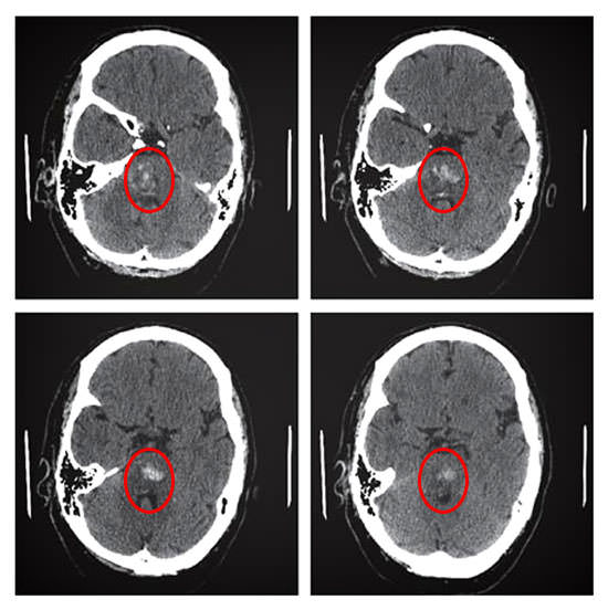 КТ головного мозга