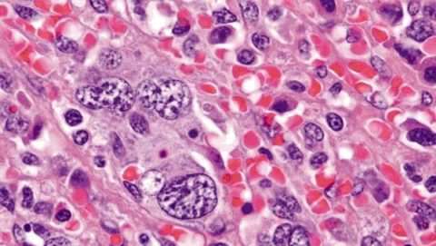 mielofibroz_mikropreparat Как диагностировать и лечить миелофиброз?