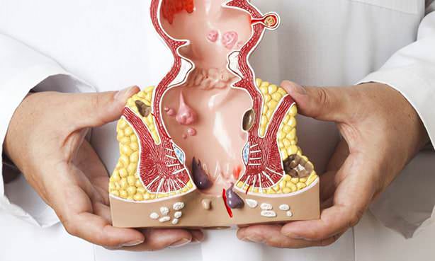 Внутренние геморроидальные шишки