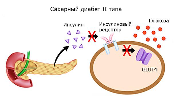 Патогенез СД 2 типа