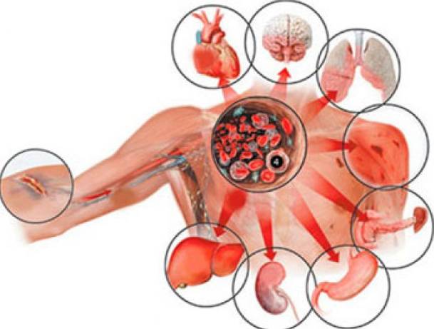 Сепсис крови что это такое, последствия и лечение
