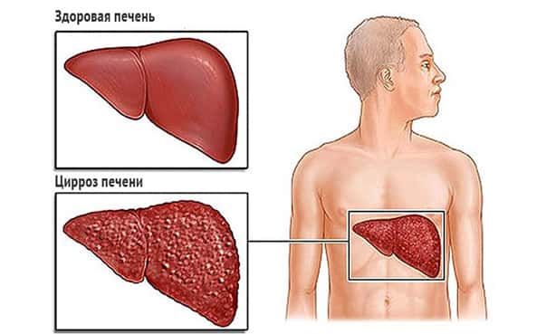 Цирроз печени
