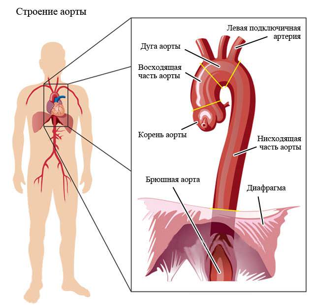 Места поражения аорты атеросклеротическими бляшками