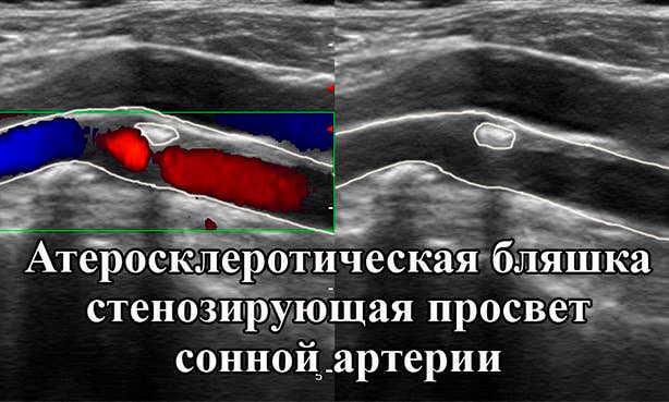 Стеноз коронарной артерии на УЗИ