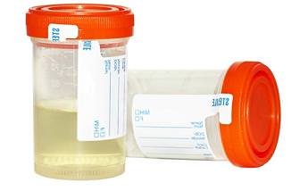 эритроциты в моче