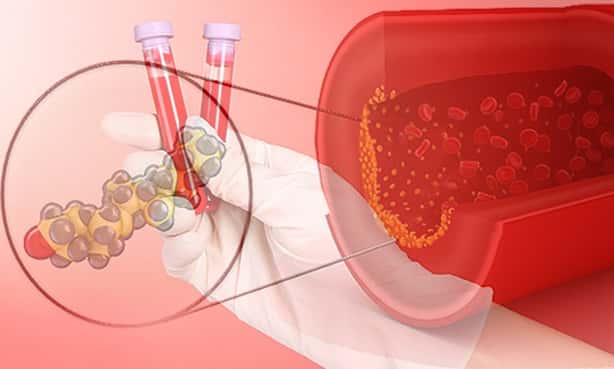 Холестерин – анализ крови
