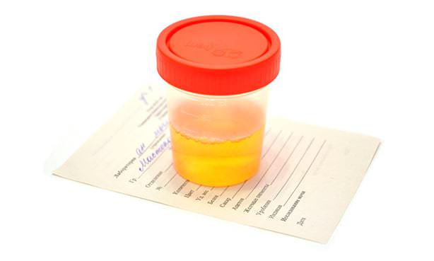 Анализ мочи