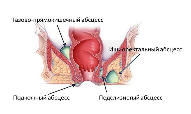 Локализация абсцессов прямой кишки