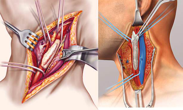 Операционный разрез в области сонной артерии