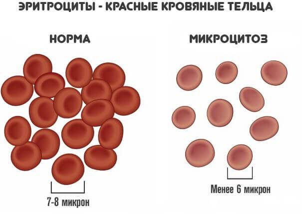 микроцитоз в крови