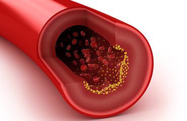 Повышенный холестерин что делать