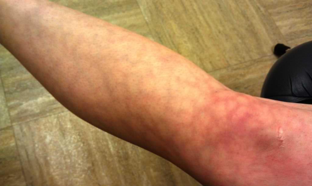 Каковы причины мраморной кожи у взрослых и детей. Симптомы, диагностика и лечение