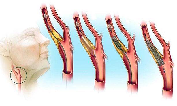 Стентирование сонной артерии