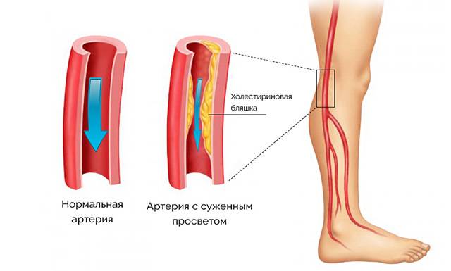 Атеросклероз сосудов