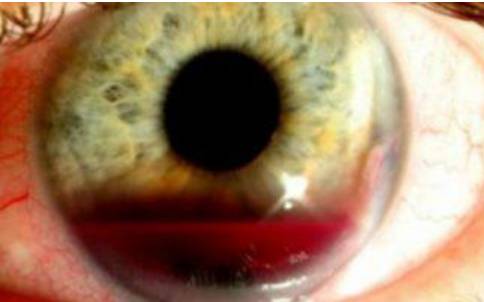 Лопнул сосуд в глазу причины, что делать и как лечить