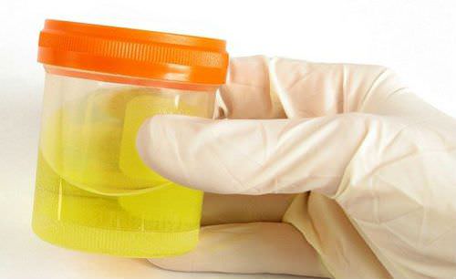 Анализ мочи Анализ мочи