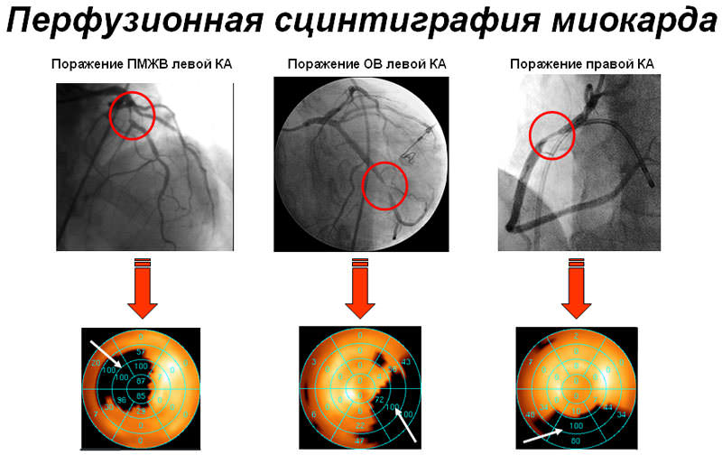 Перфузионная сцинтиграфия