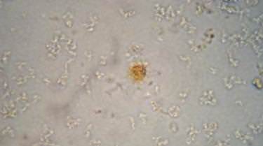 в моче билирубин повышен