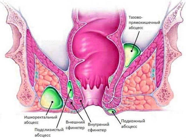 Парапроктит