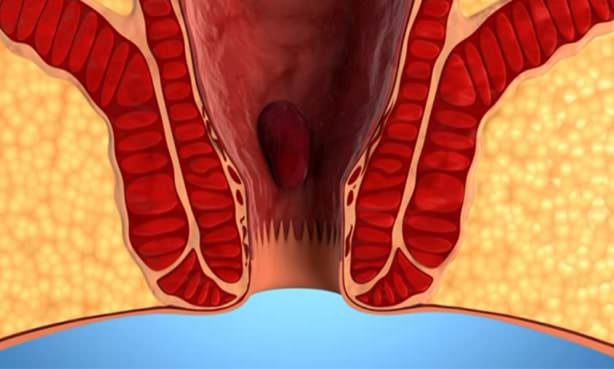 Геморрой 1 степени