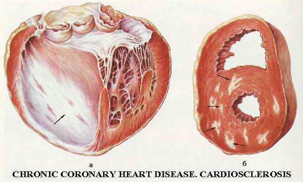 Постинфарктный крупноочаговый кардиосклероз