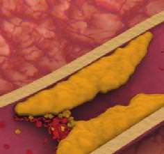 высокий холестерин