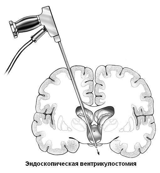 Вентрикулостомия
