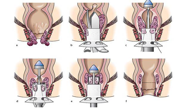 Ход операции геморроидопексии