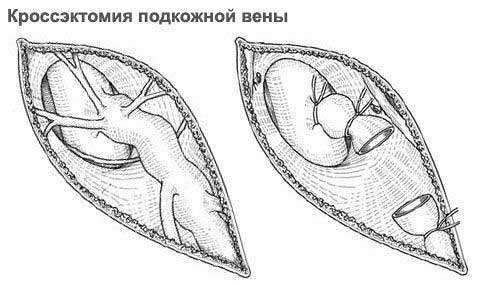 Кроссэктомия