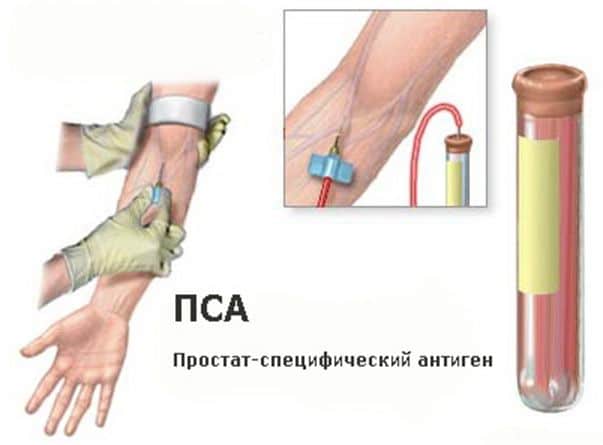 что такое анализ на ПСА