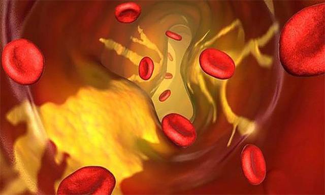 Холестериновая бляшка