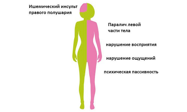 Осложнения правостороннего инсульта
