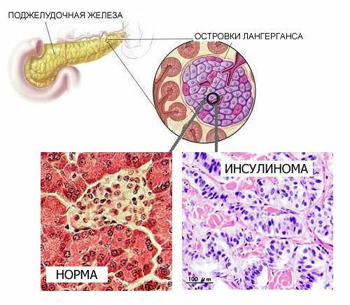 Инсулинома Инсулинома