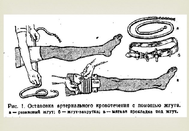 Правила наложения жгута