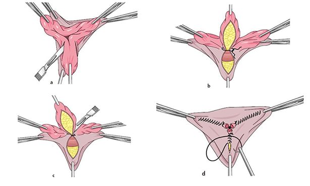 Закрытая геморроидэктомия с ушиванием раны