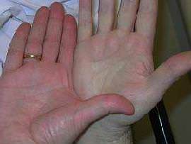 Пониженный гемоглобин симптомы