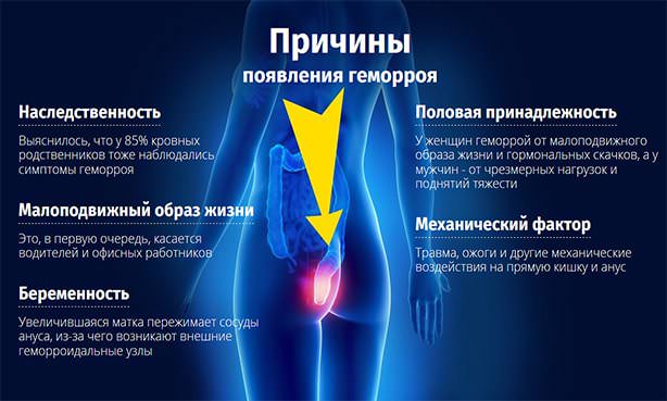 Причины геморроидальной болезни