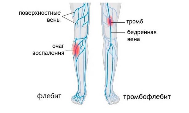 Флебит вен нижних конечностей