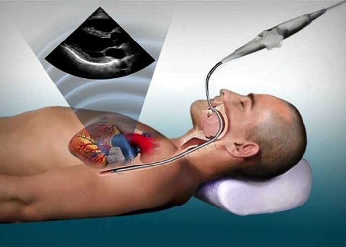 Чреспищеводная ЭхоКГ