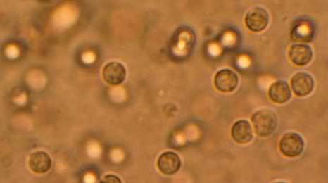 Лейкоциты в моче