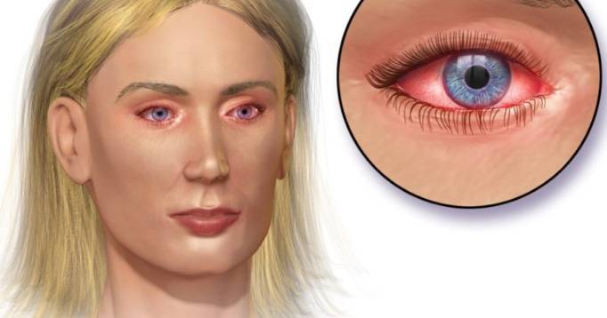 Лопнул сосуд в глазу причины, что делать и как лечить