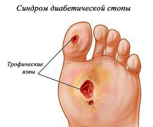 Синдром диабетической стопы